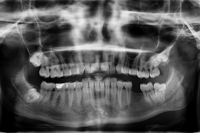 rêver de perdre ses cheveux
